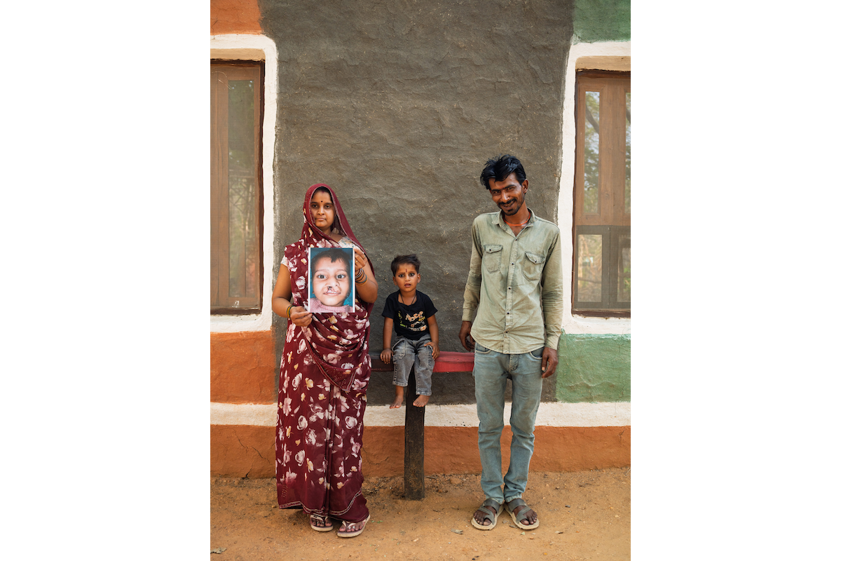 Robi is the 7,000th patient to receive cleft surgery through the partnership between Smile Train and Dentsply Sirona.