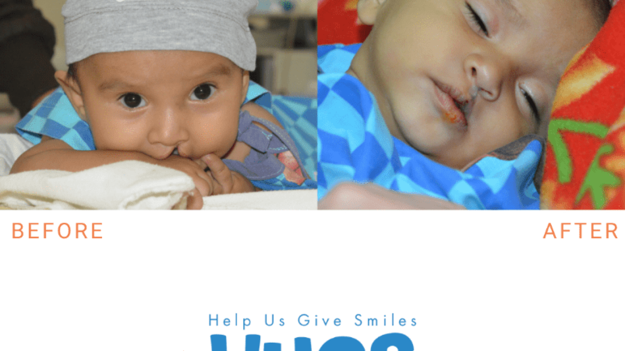 A child's before and after photo from surgery